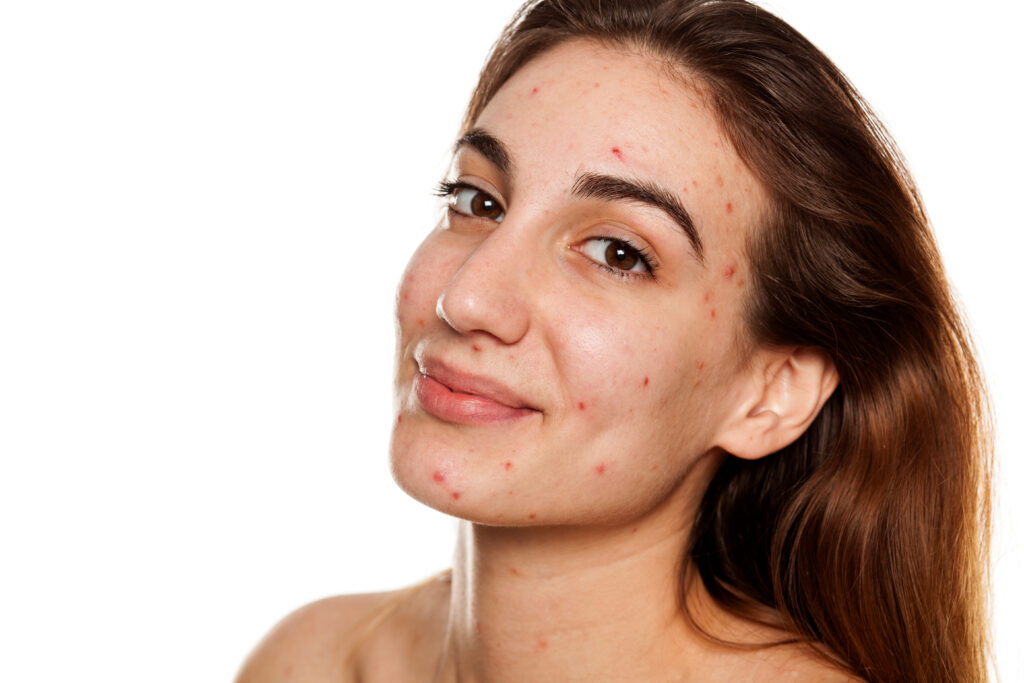 4. Eating Chocolate Causes Acne